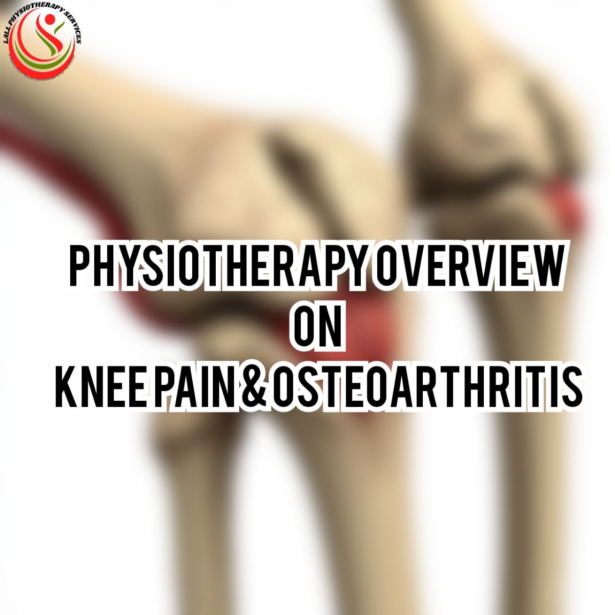 Physiotherapy Overview on Knee Pain and Osteoarthritis